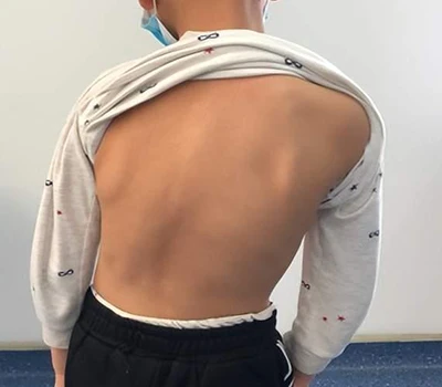 Skolioosin seulonta ja hoito: Kuinka Xianku 3D Body Scanner auttaa kiropraktikoita