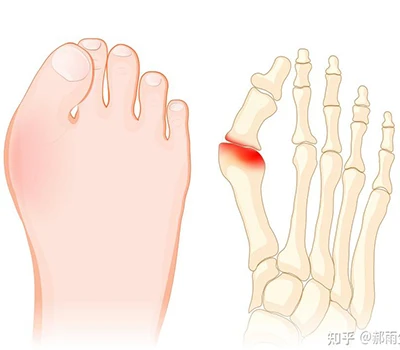 Hallux Valgus: Täydellinen tiedeopas