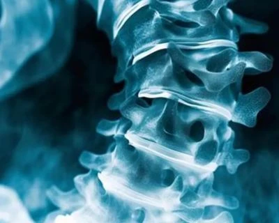 AI skolioosiseulonta ja selkärangan kohdistuksen seuranta: älykkäämpi 3D-terveysseulontaratkaisu ...
