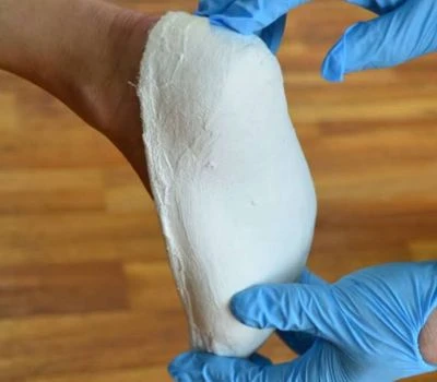 Kuinka 3D-jalkaskannerit muuttavat ortopedisten tukilaitteiden tulevaisuuden?