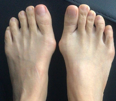 Hallux Valgus -mittaus: Miksi 3D -skannerit ylittävät lääkäreitä ja sairaaloita