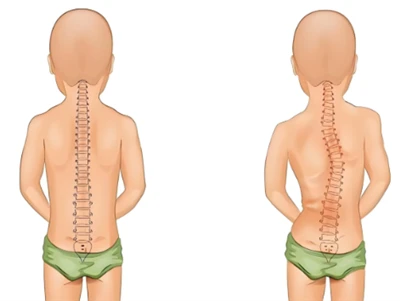 Uusi skolioosin seulontamenetelmä: AI & 3D Digital Spine